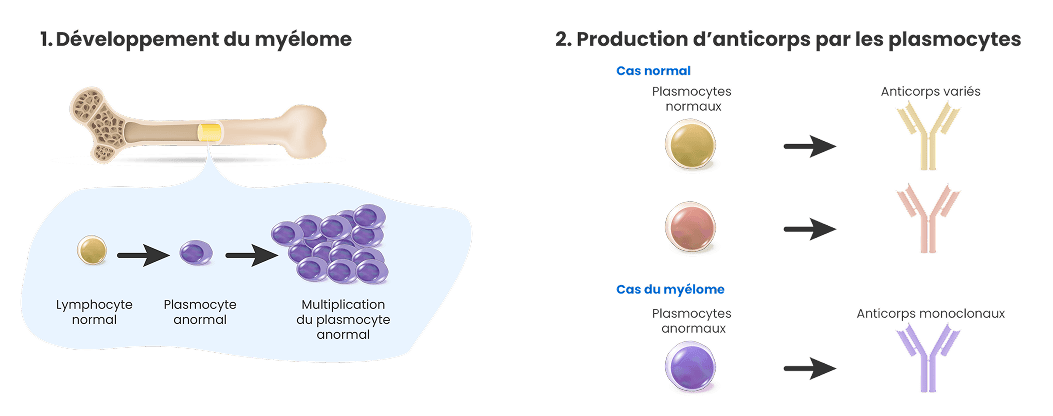 Le développement du myélome multiple