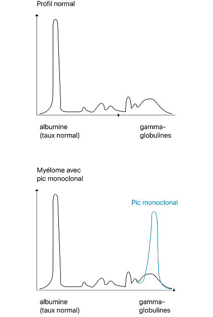 Electrophorèse des protéines sériques