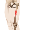 Les fractures